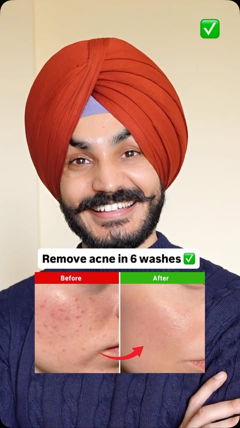 Instagram post by @santwinder_singh_waraich for Novology. Caption reads: [...] rid of pimples in just 6 washes 
 with....