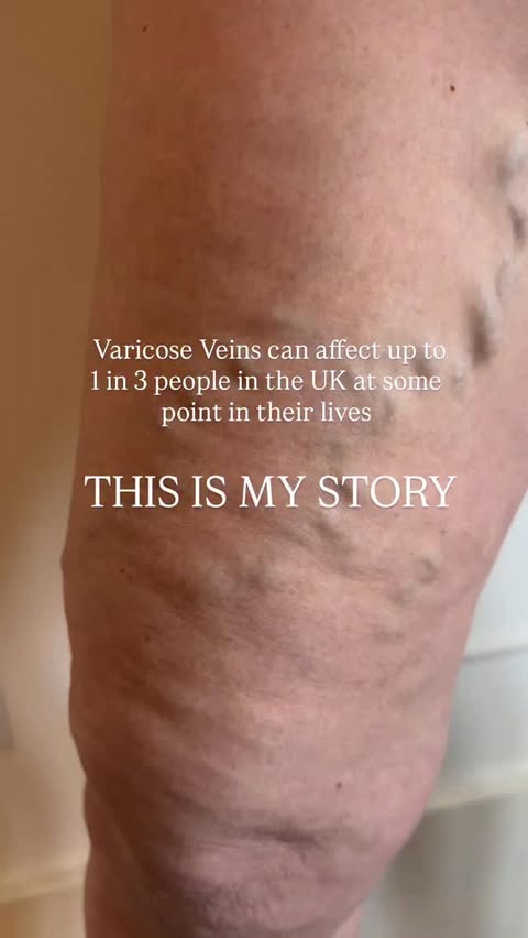 Instagram post by an influencer for Veincentre. Caption reads: [...] to the lovely people at @veincentreofficial....