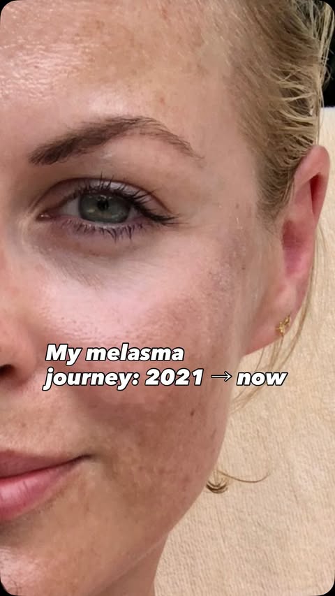 Instagram post by @alibaileylondon for Dermatica. Caption reads: [...] my skin has come since 2021. To try....
