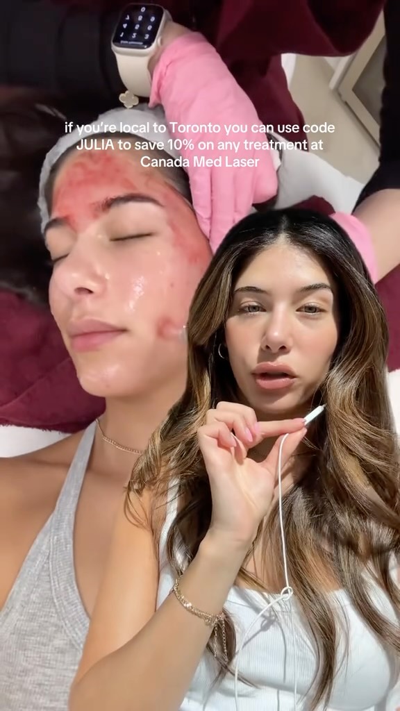 Instagram post by @juliaperfetto for NUDESTIX. Caption reads: How I lighten post-acne scars:

1. Microneedling....