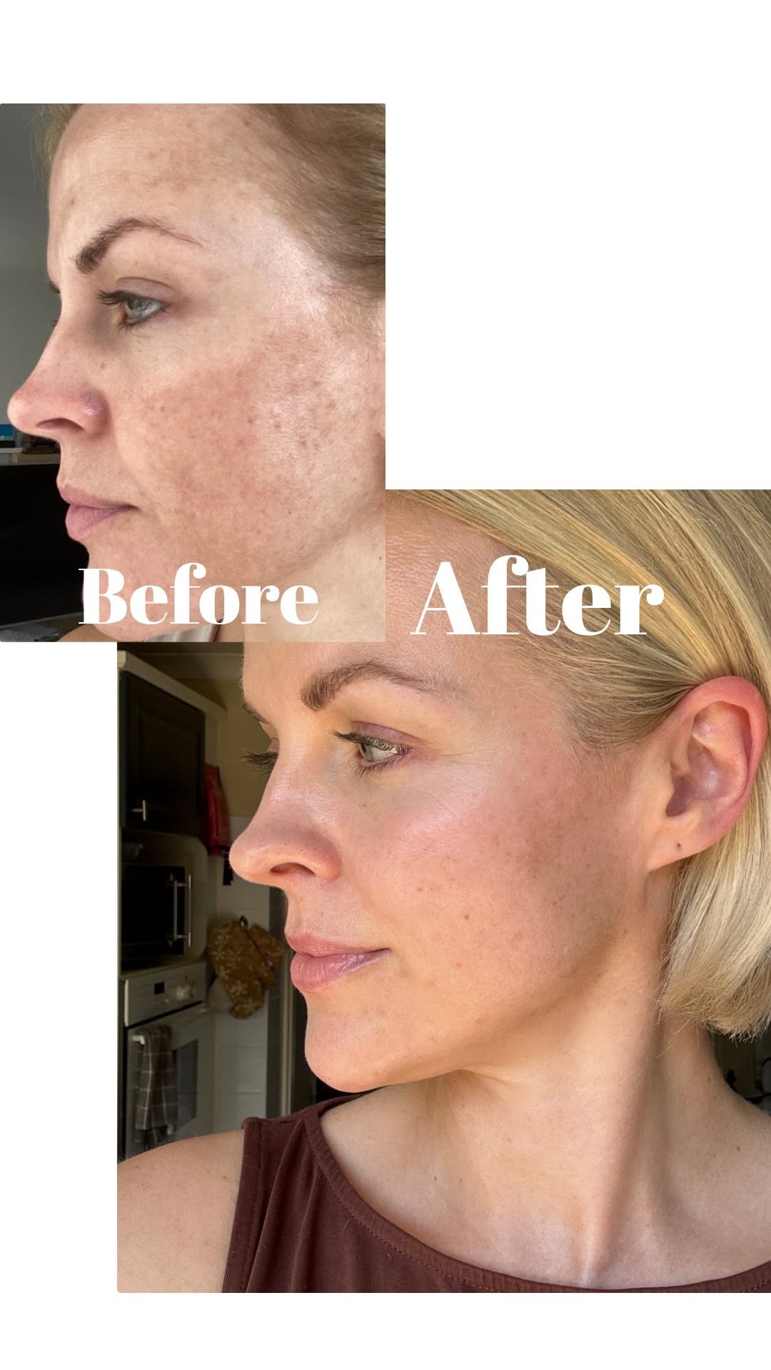 Instagram post by @alibaileylondon for Dermatica. Caption reads: ad

I first started using @dermatica.skin....