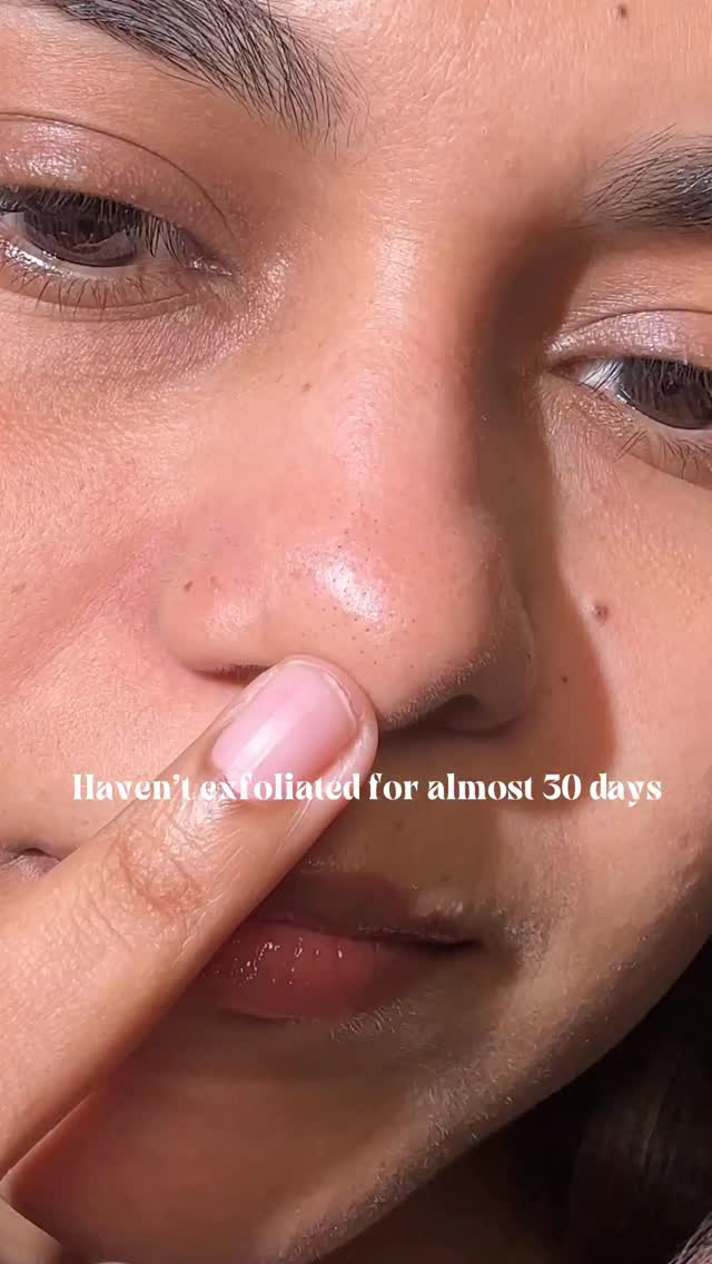 Instagram post by @lovedbymercybivin for APRILSKIN. Caption reads: Skin detox ✨ #poresandblackheads 

After all the....