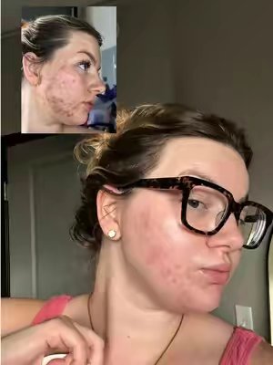 TikTok post by @marisshopfinds for CLEARSTEM Skincare. Caption reads: [...] a difference for my hormonal acne @CLEARSTEM....