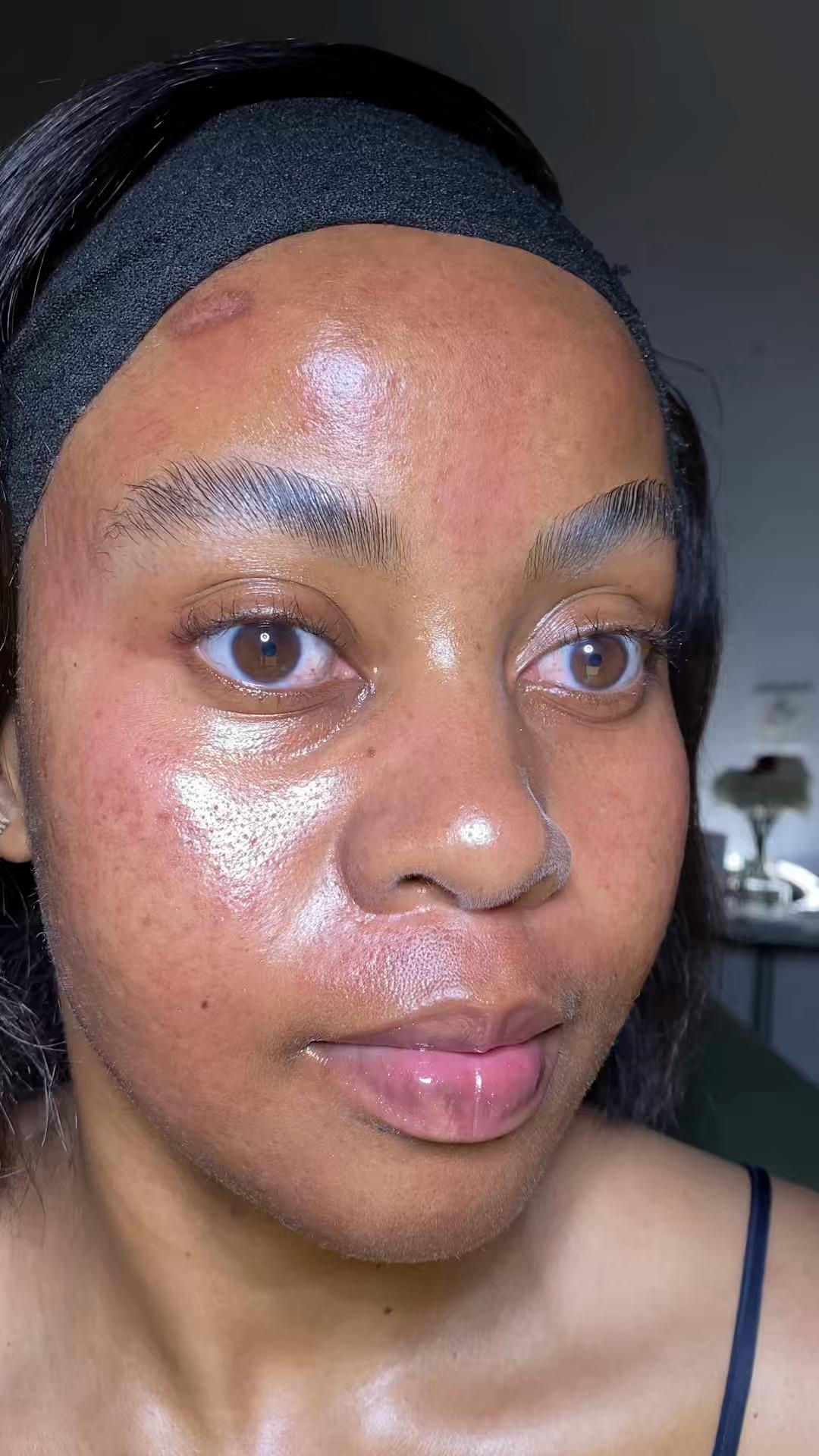 TikTok post by @simphiwee_mb for Banish. Caption reads: [...] #realskin #acnescars #acne @BANISH.