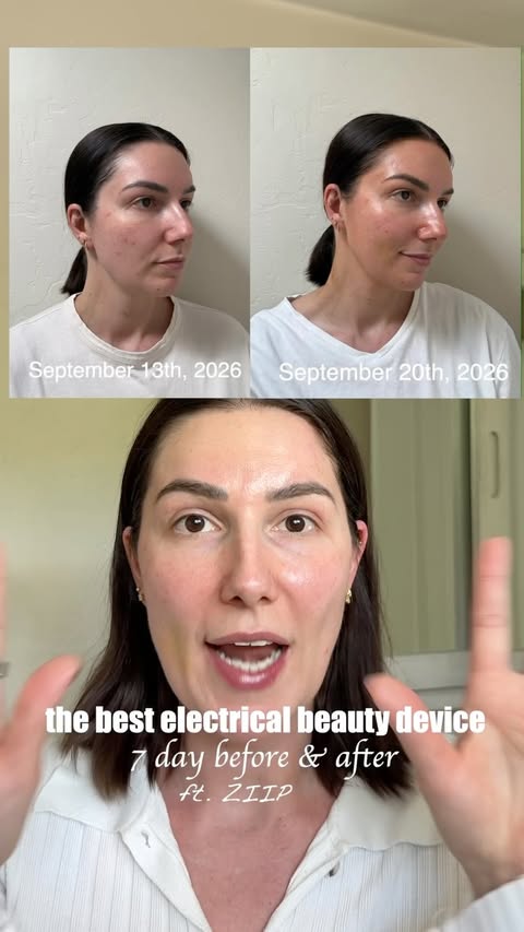 Instagram post by @adaatude for ZIIP. Caption reads: this is a 7 day before & after using @ziipbeauty....
