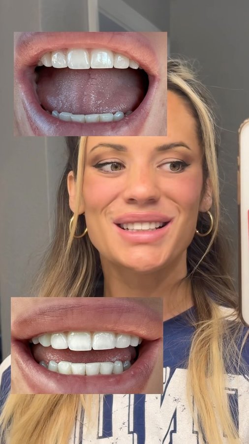 Instagram post by @tillywhitfeld for White Glo. Caption reads: For 10 minutes a day and visible results right....