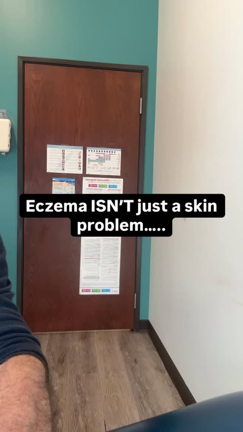 Instagram post by @drmichaelmilobsky for MaryRuth's. Caption reads: Eczema isn’t just a skin condition. It’s an immune....
