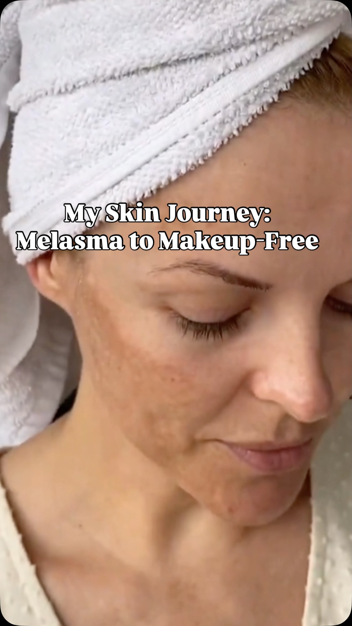 Instagram post by @alibaileylondon for Dermatica. Caption reads: Melasma showed up for me when I was 25 (that’s a....
