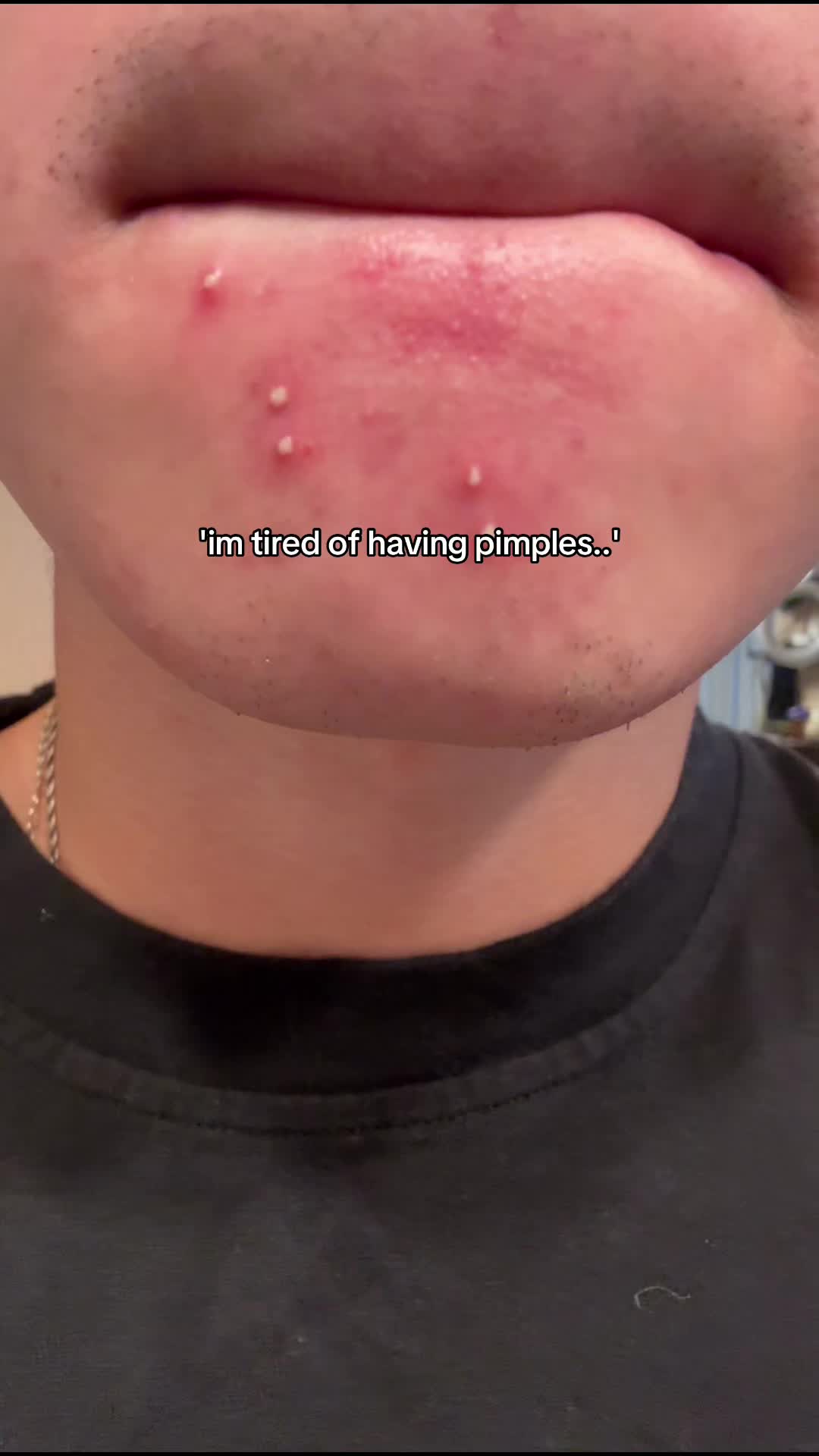 TikTok post by @detected101 for Osaka Ebisu. Caption reads: [...] #pimples #clearskin #japaneseskincare @Osaka....