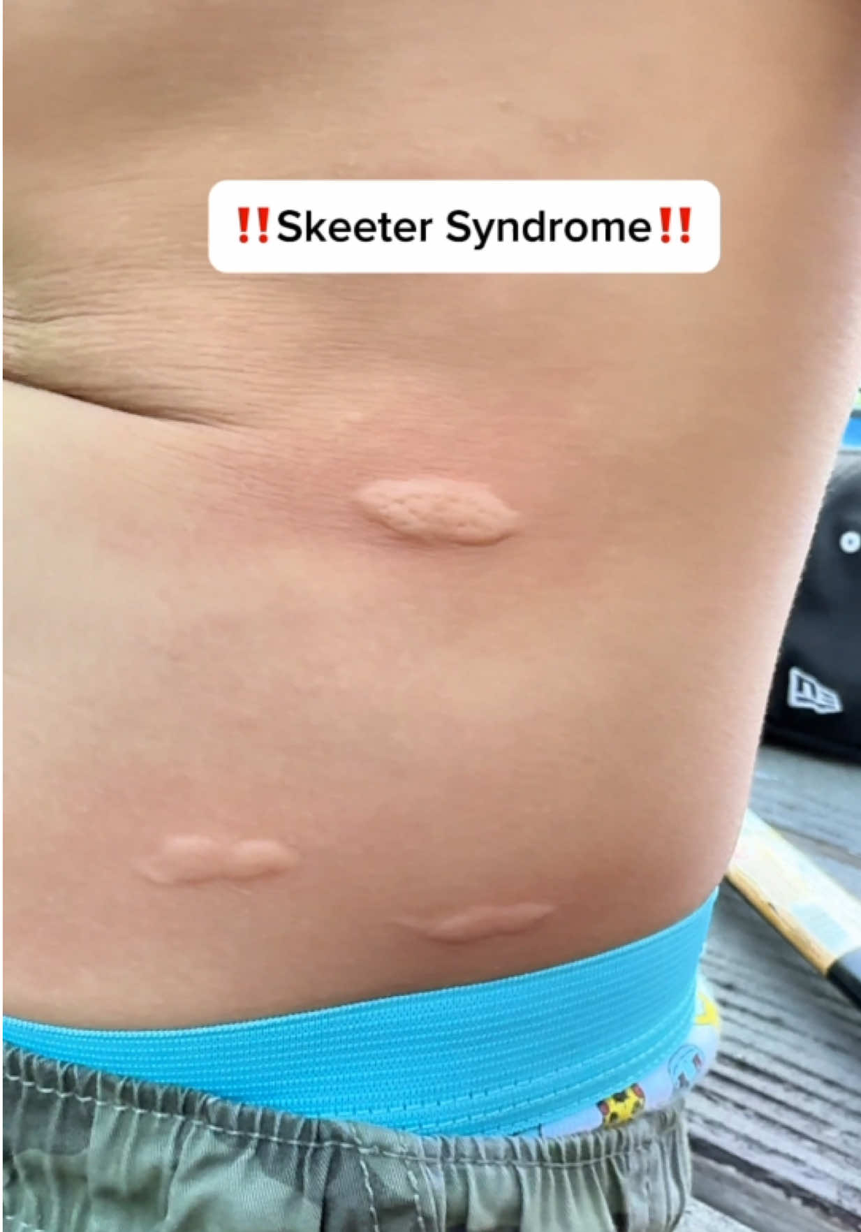 TikTok post by @malia808 for Bug Bite Thing. Caption reads: [...] a problem in your area you need the bug bite....