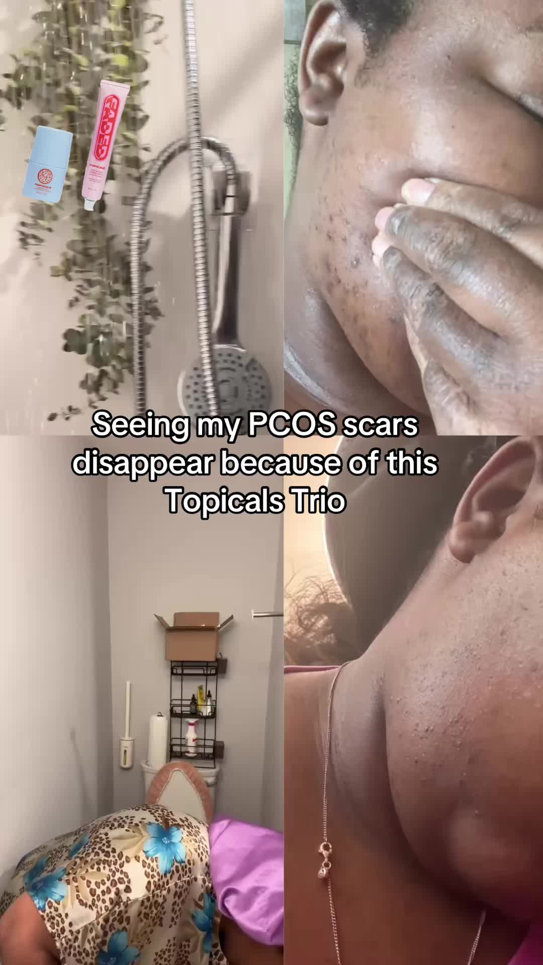 TikTok post by @fromlolawithlove for TOPICALS. Caption reads: [...] #hirsutism caused by #pcos. @TOPICALS....