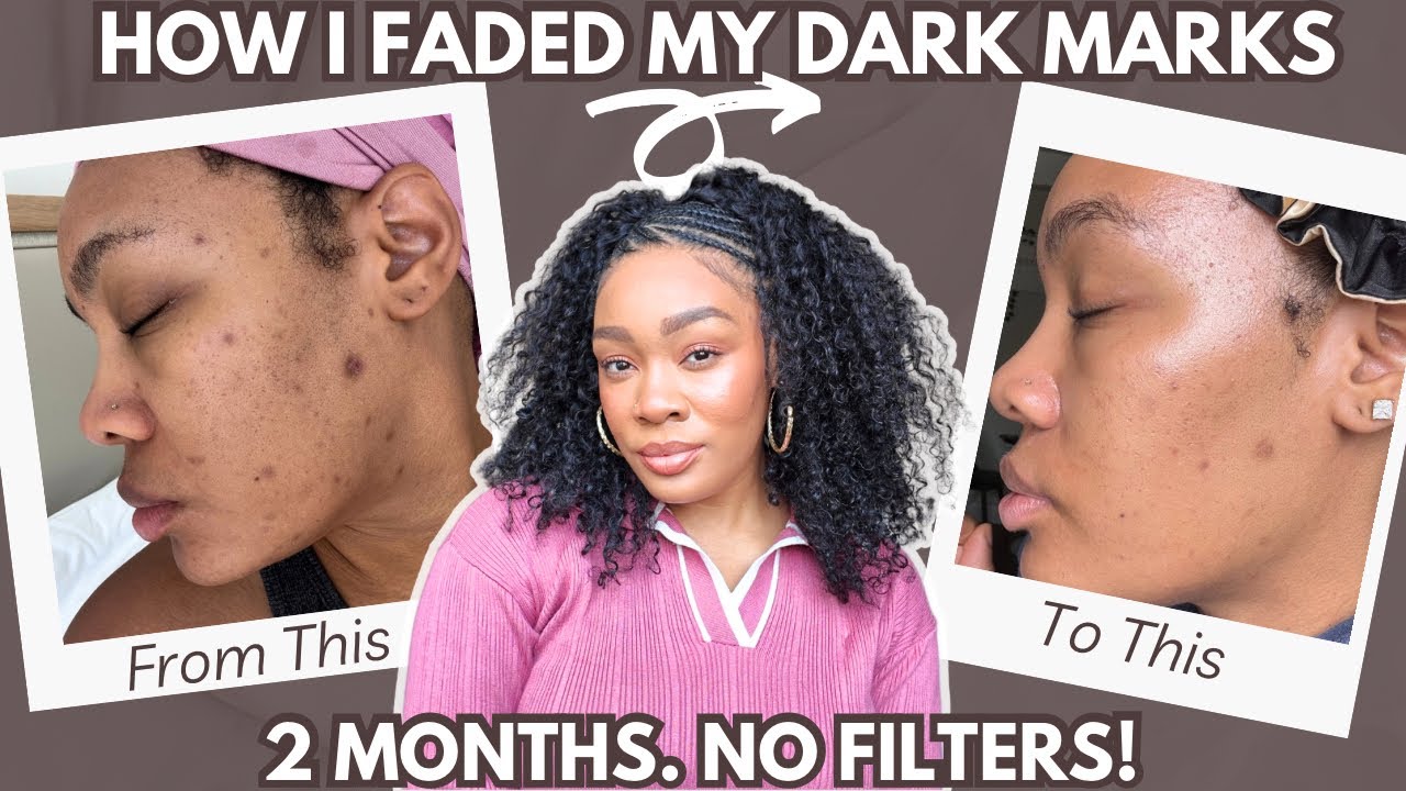 YouTube post by @BohoGuru for TrueSeaMoss. Caption reads: ✨ I finally faded my dark marks + acne scars in....