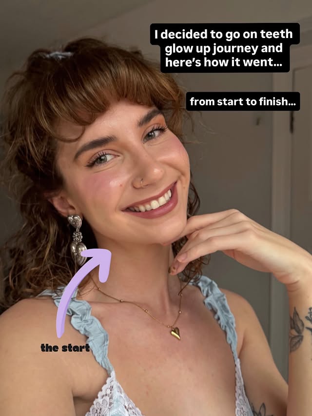 Instagram post by @summerfox___ for Invisalign. Caption reads: [...] I didn’t think they were that wonky!....