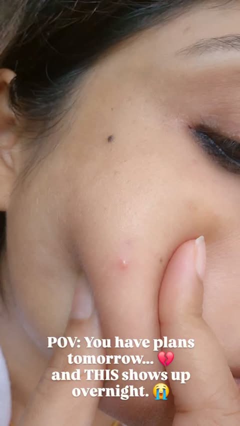Instagram post by @ayaansisters for ThePinkPantherCo. Caption reads: You know it's serious when a surprise pimple shows....
