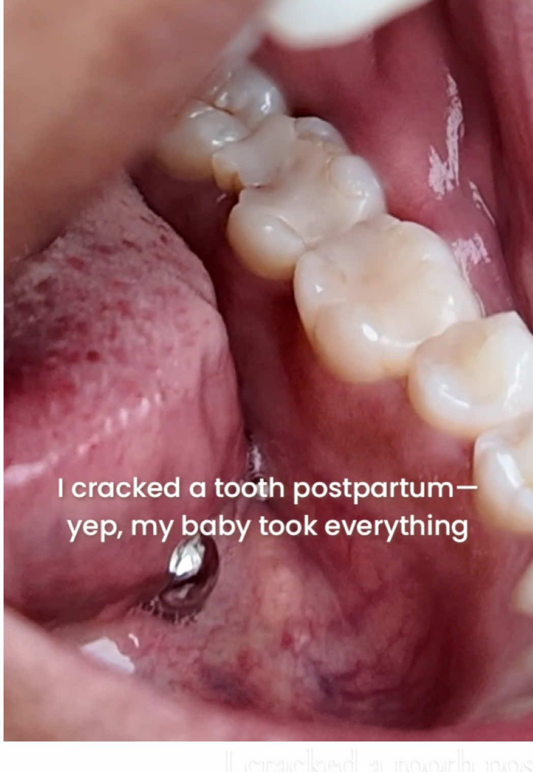 TikTok post by @themicrolocdmom for MaryRuth Organics. Caption reads: I cracked a tooth postpartum… and that’s when it....