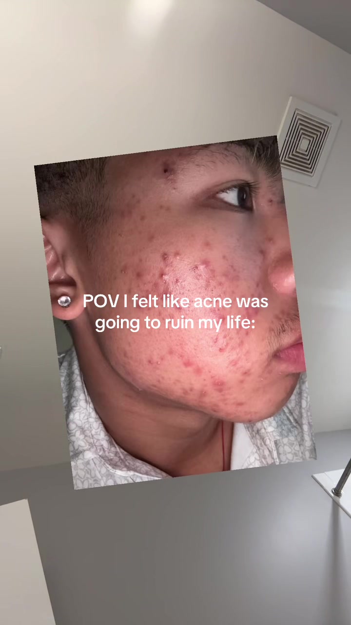 TikTok post by @austinree1s for Osaka Ebisu. Caption reads: [...] acne cream actually saved my skin 😭 @Osaka....