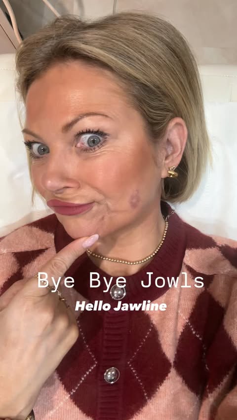 Instagram post by an influencer for Vanity Lab London. Caption reads: [...] So I’ve started HIFU @vanitylablondon to....