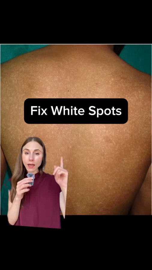 Instagram post by @drdrayzday for PanOxyl. Caption reads: Dermatologist explains: the truth about white skin....