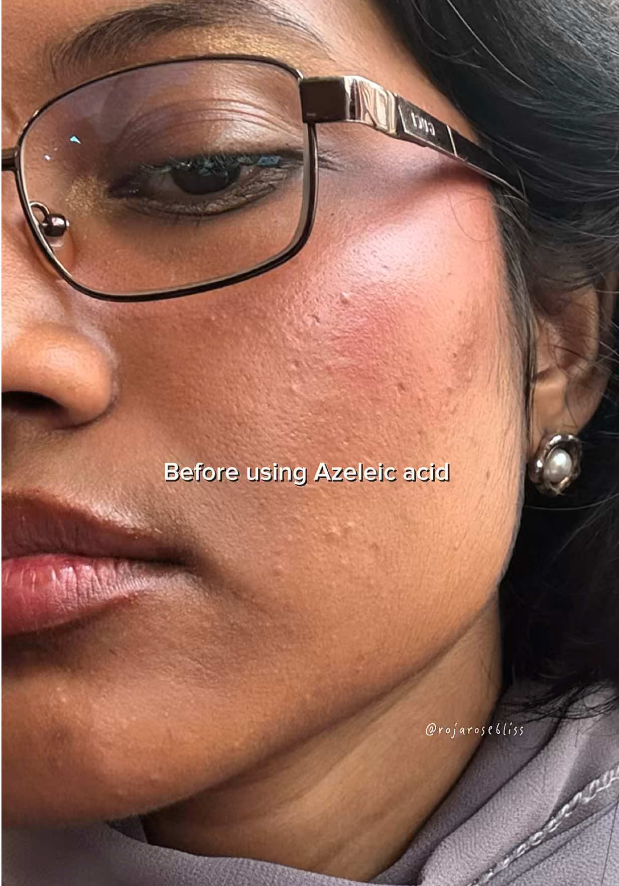 TikTok post by @rojarosebliss for ANUA Skincare KR. Caption reads: Save & use💌✨ . . . @anua_global Azeleic acid....