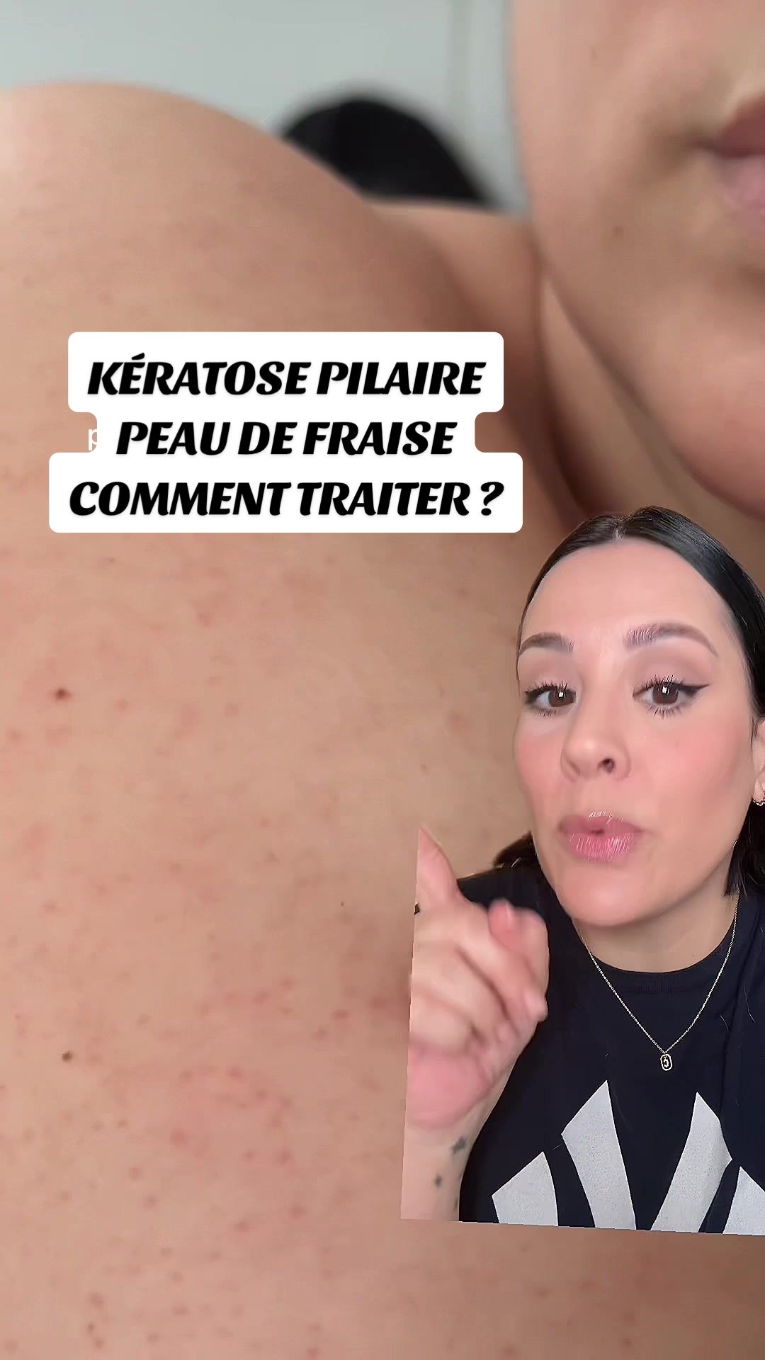 TikTok post by @frenchtouchofmakeup for First Aid Beauty. Caption reads: Kératose pilaire 2 étapes pour....