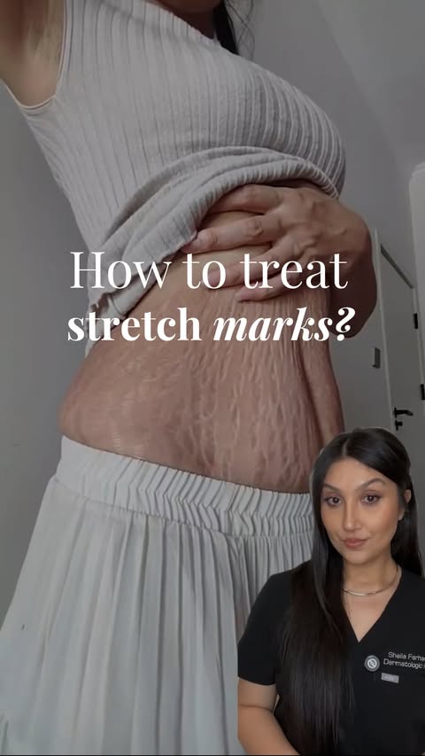 Instagram post by @dr.sheila_derm for PALMERS. Caption reads: Comment “stretch marks” for a list of products....