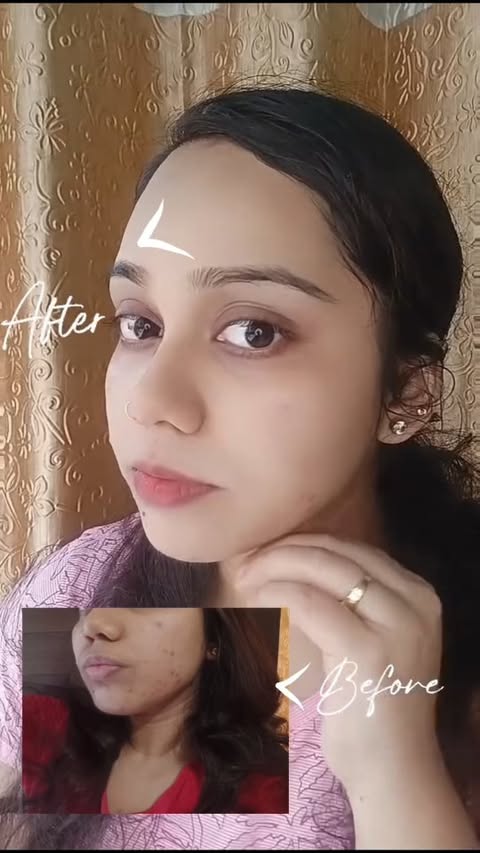 Instagram post by @parna.banerjee_ for D'Acne by Glenmark. Caption reads: #AD Your skin deserves an upgrade, and so does....