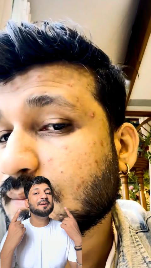 Instagram post by @belikeabhii for Novology. Caption reads: Pimples ko ignore karna band karo! 👀 Novology....