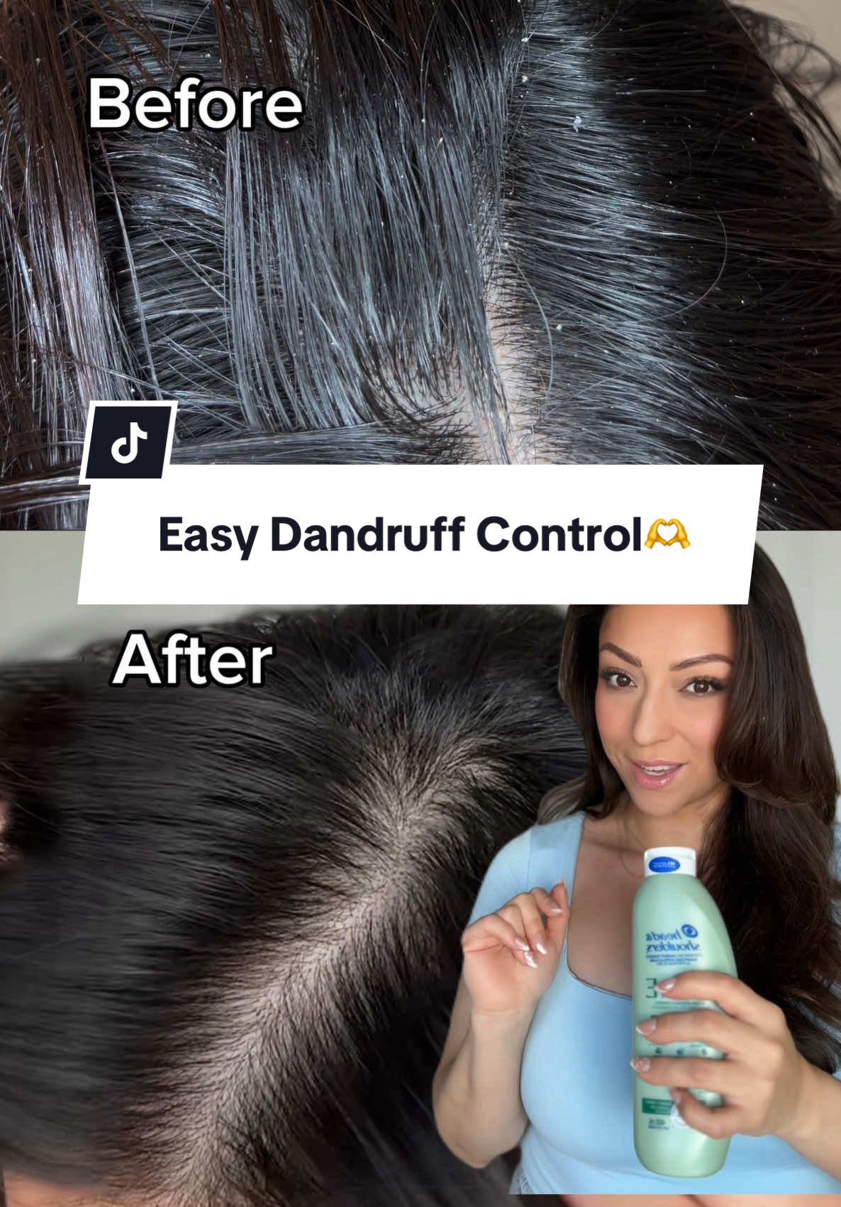 TikTok post by @karlakazemi for Head&Shoulders. Caption reads: If you're like me and have dandruff, use....