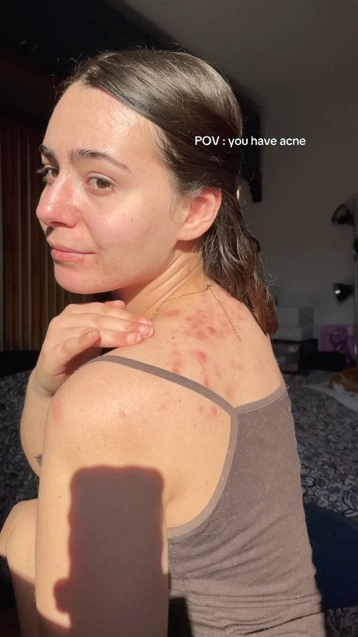 Instagram post by @selflove_aida for Facetheory. Caption reads: Having acne on your back can be super hard to live....