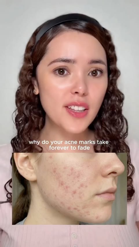 Instagram post by @illaalvarez for Dear, Klairs US. Caption reads: your acne marks aren’t stubborn… your skin just....