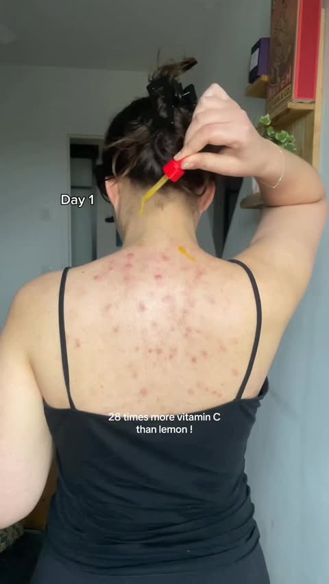Instagram post by @selflove_aida for EQQUALBERRY Global Official. Caption reads: Dealing with back acne hasn’t always been easy,....