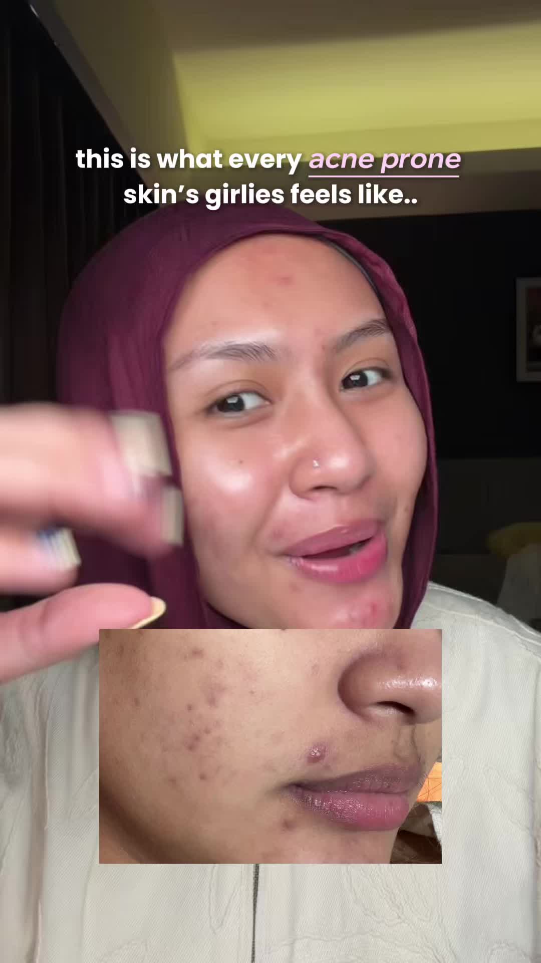 TikTok post by @amekajaa for Nurilab.id. Caption reads: [...] #CoverToRecover #ObatTotolJerawat....