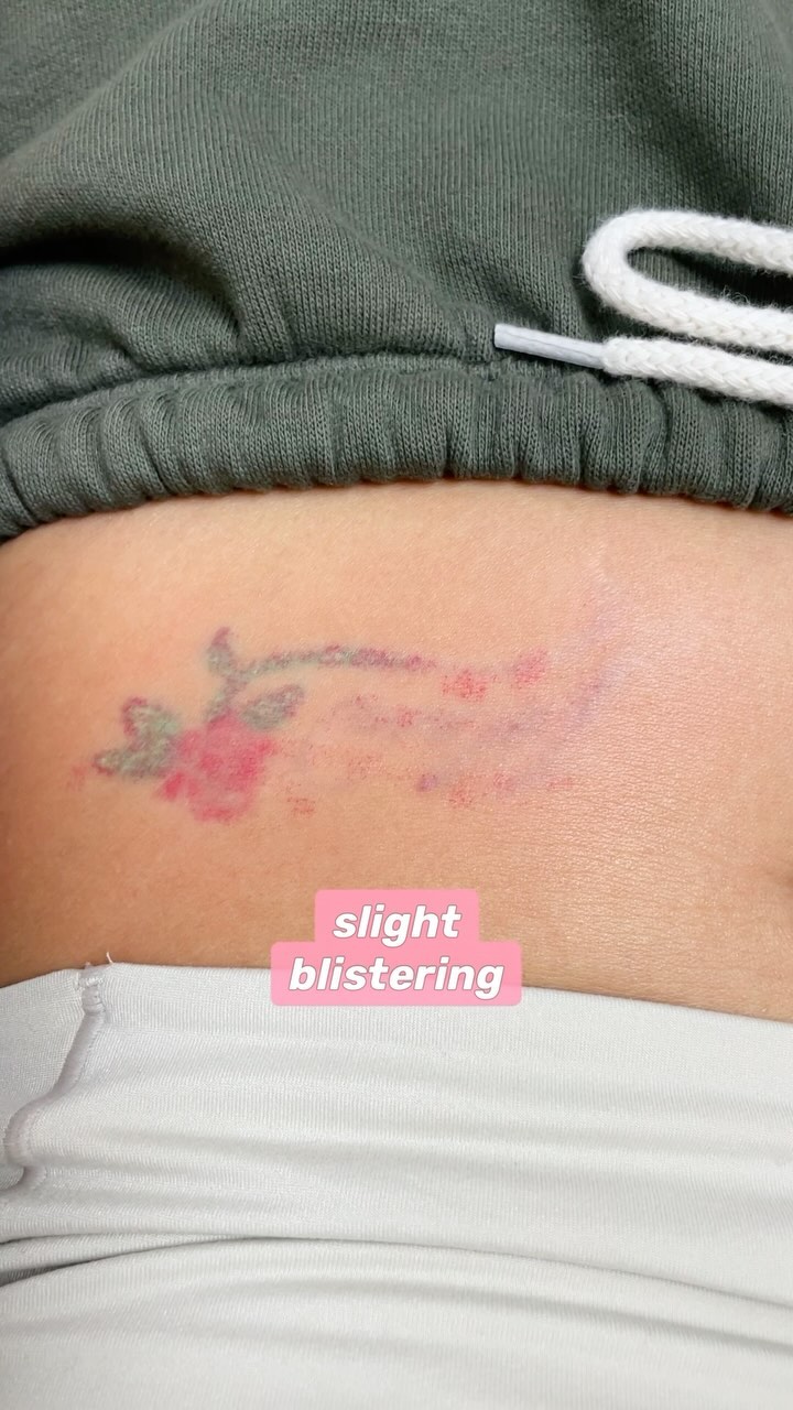 Instagram post by @joleendiaz for LaserAway. Caption reads: almost gone…colored ink may never fully fade, i’m....