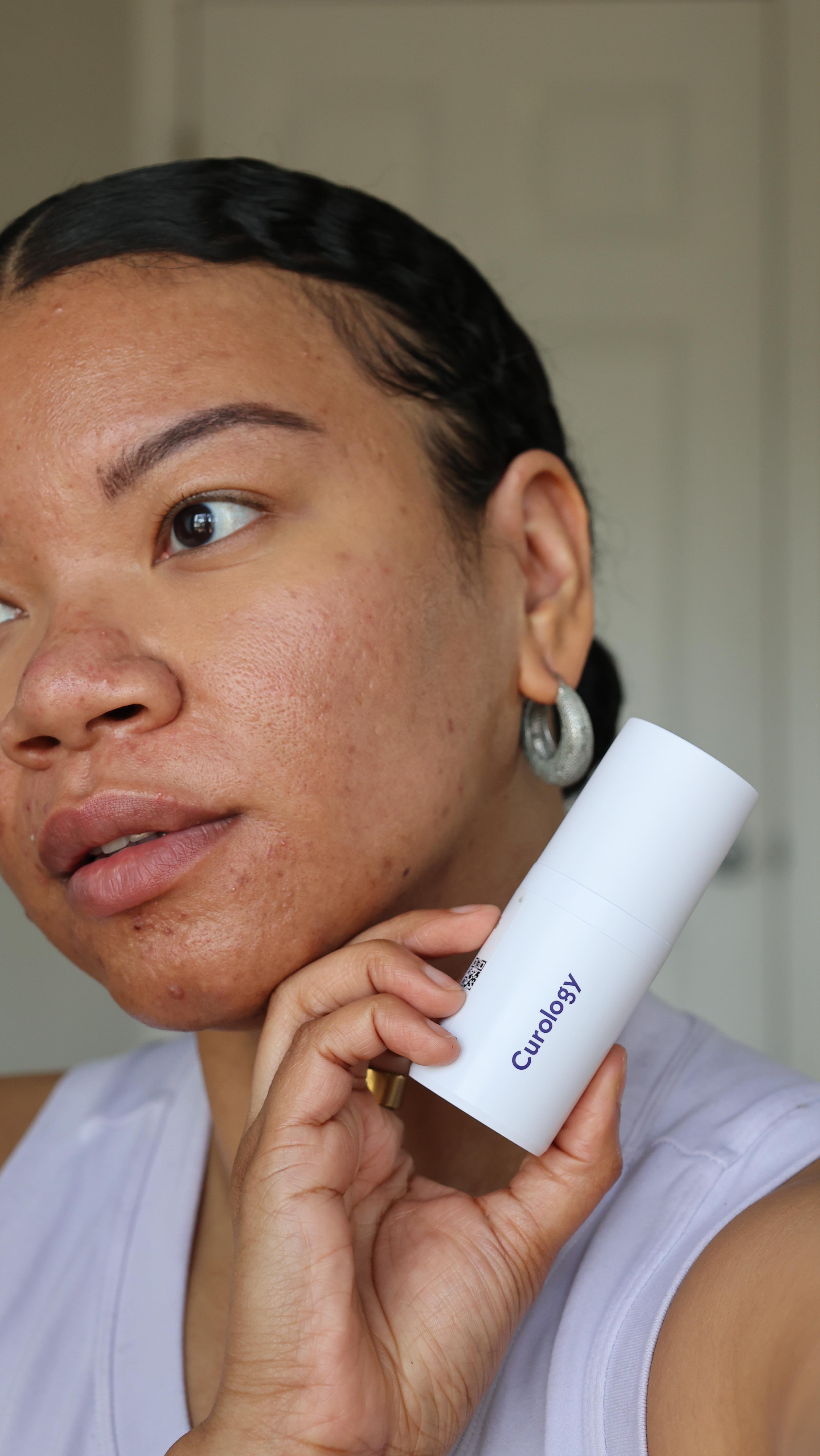 Instagram post by @theblendedbeauty for Curology. Caption reads: #curologypartner | treating my post pill acne

In....