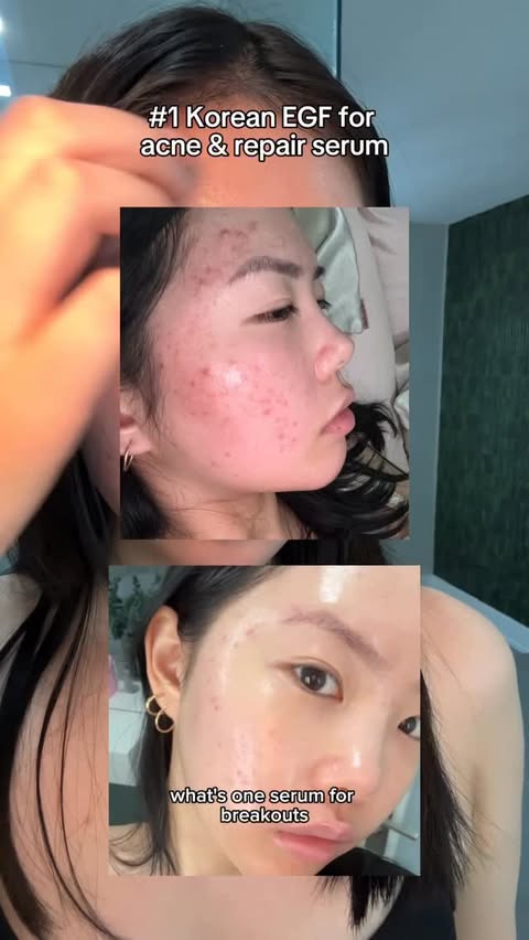 Instagram post by @bykristinanguyen for Dear, Klairs US. Caption reads: Korean serum for acne repair with @klairs.us EGF....
