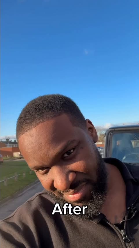 Instagram post by @axelblake for Estenove. Caption reads: AD Hair transplant at @estenoveturkey finally paid....