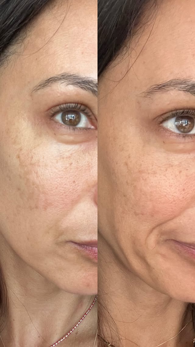 Instagram post by @mills.liberty for Balance Me Natural Skincare. Caption reads: My natural solution to pigmentation 🌱 Finally.....