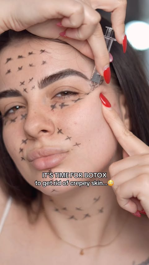 Instagram post by @julia__hauls for numbuzin. Caption reads: [...] FOR BOTOX to get rid of crepey skin…😳....