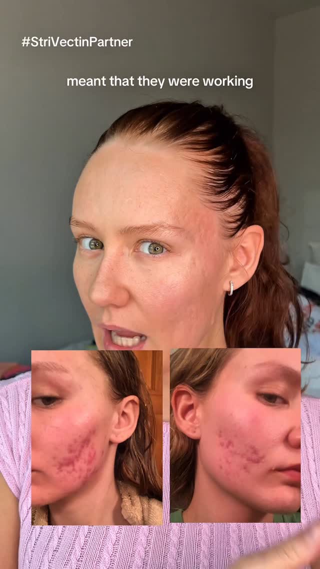 Instagram post by @theblemishqueen for StriVectin. Caption reads: My blackhead LITERALLY FELL OUT OF MY FACE 😳…....