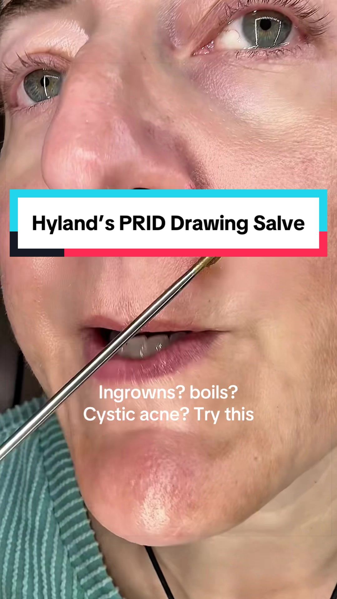 TikTok post by @holli_unfiltered for Hyland's Naturals. Caption reads: #ingrownhair #boils #bugbites #homeopathic....