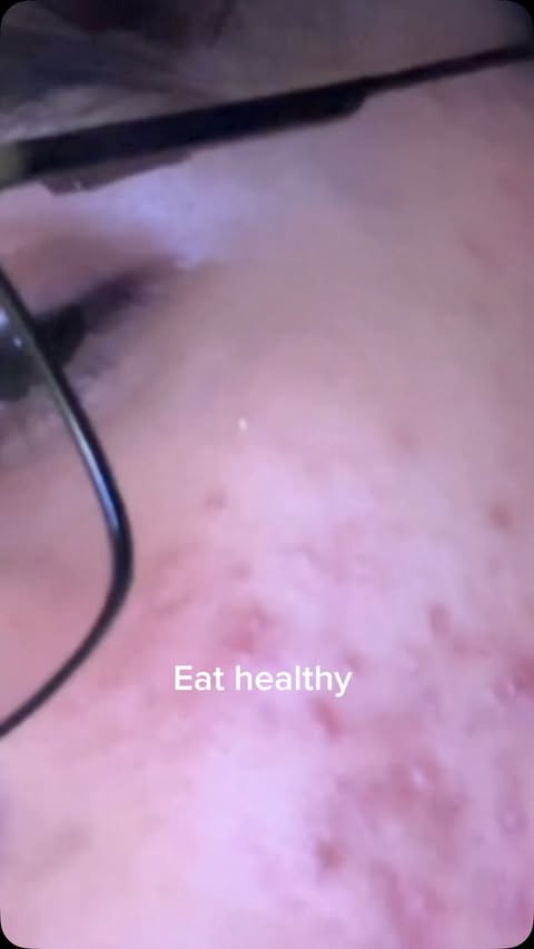 Instagram post by @vanshsharmaa.a for Chemist at Play. Caption reads: Comment for link #acne that’s the best and....