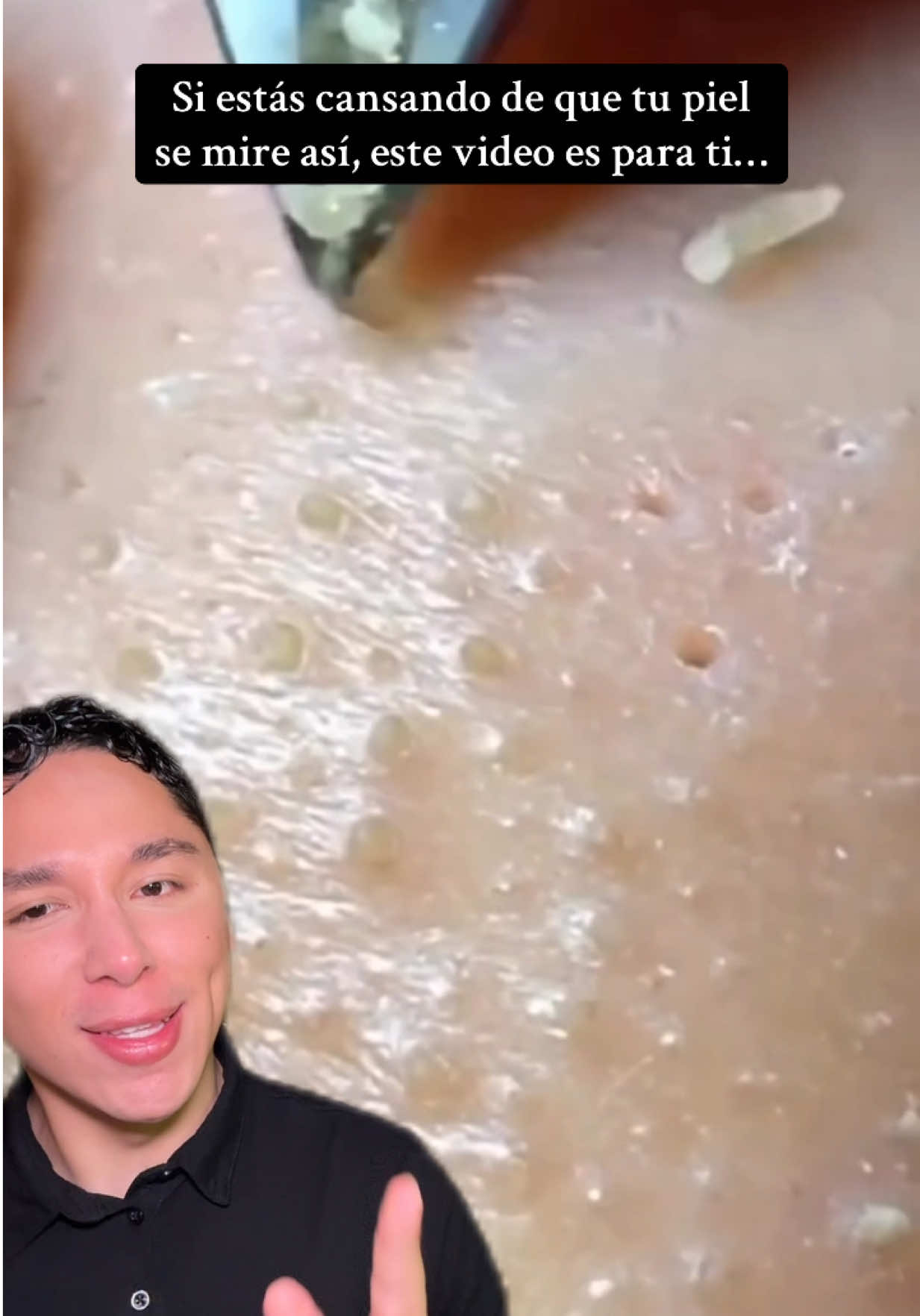 TikTok post by @carlosantoniocerv for Anua. Caption reads: @Anua Store US #Blackheads #cloggedpores [...].