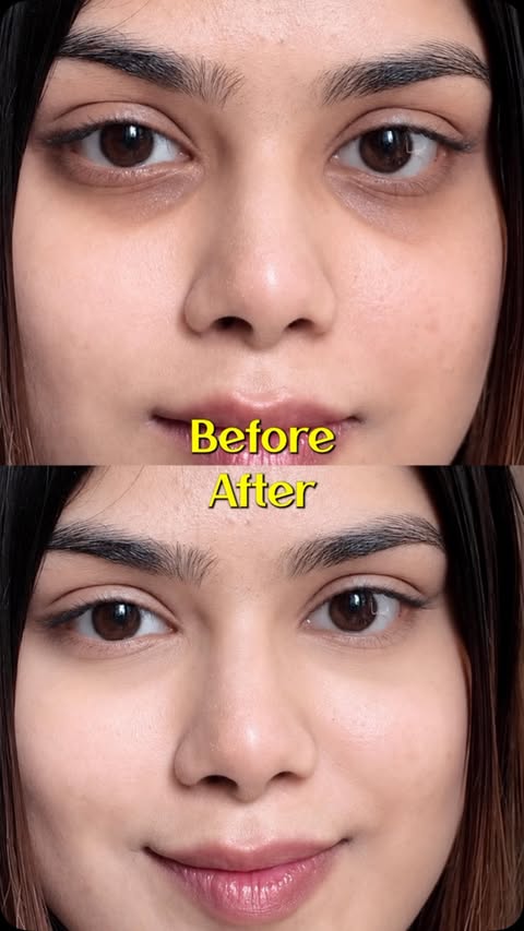 Instagram post by @try_withumang for Dr Sheths. Caption reads: [...] link 🔗 #botox #undereye #foryou #fyp....