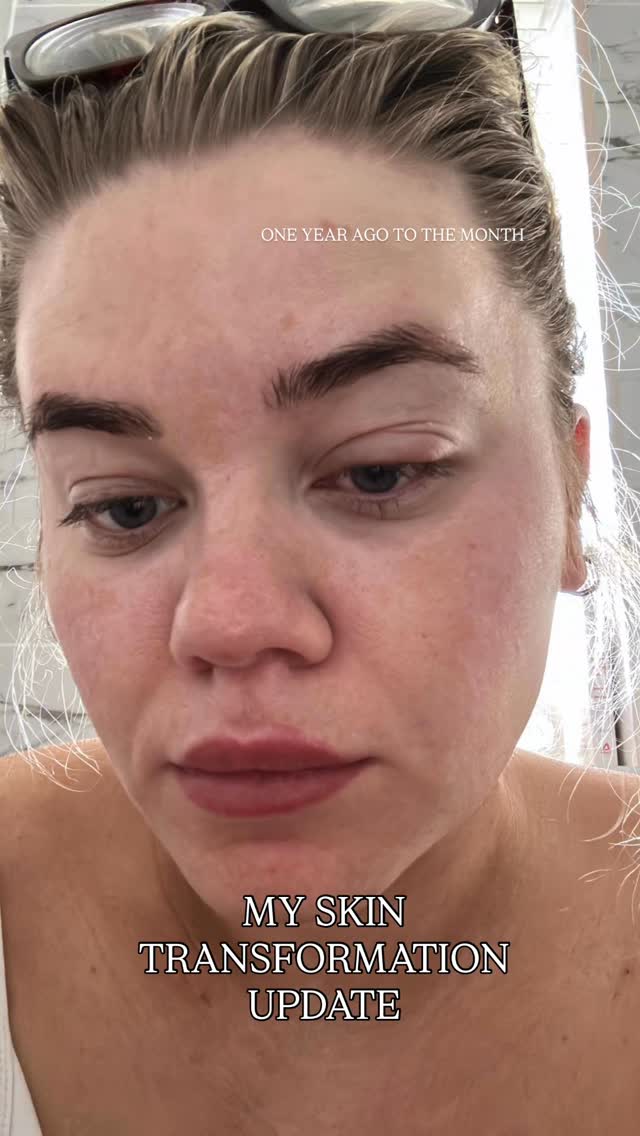 Instagram post by @katehayesmakeup for Dermatica. Caption reads: One year skin transformation with @dermatica.skin....