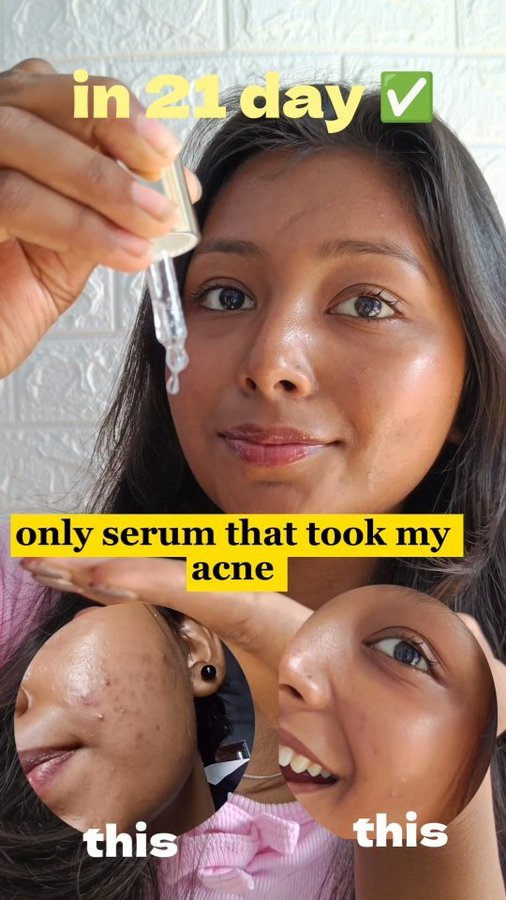 Instagram post by @thevibingvini__ for The Ayurveda Co.. Caption reads: Say Goodbye to Acne & Spots! 🌿✨
Follow and....