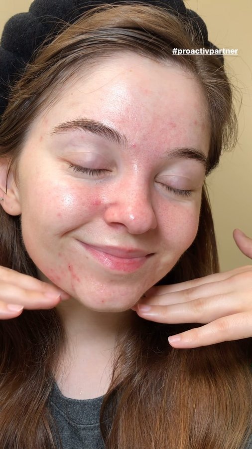Instagram post by @allywithacne for Proactiv. Caption reads: For all the acne prone girlies, you don’t need an....