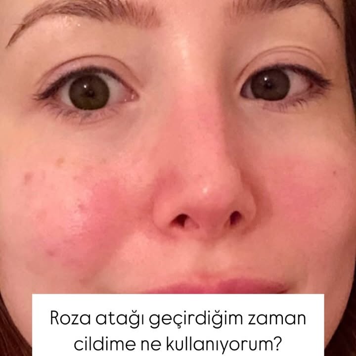 Instagram post by @hello.rozasea for Avène. Caption reads: Roza atağı geçirdiğim zaman cildimi nasıl....