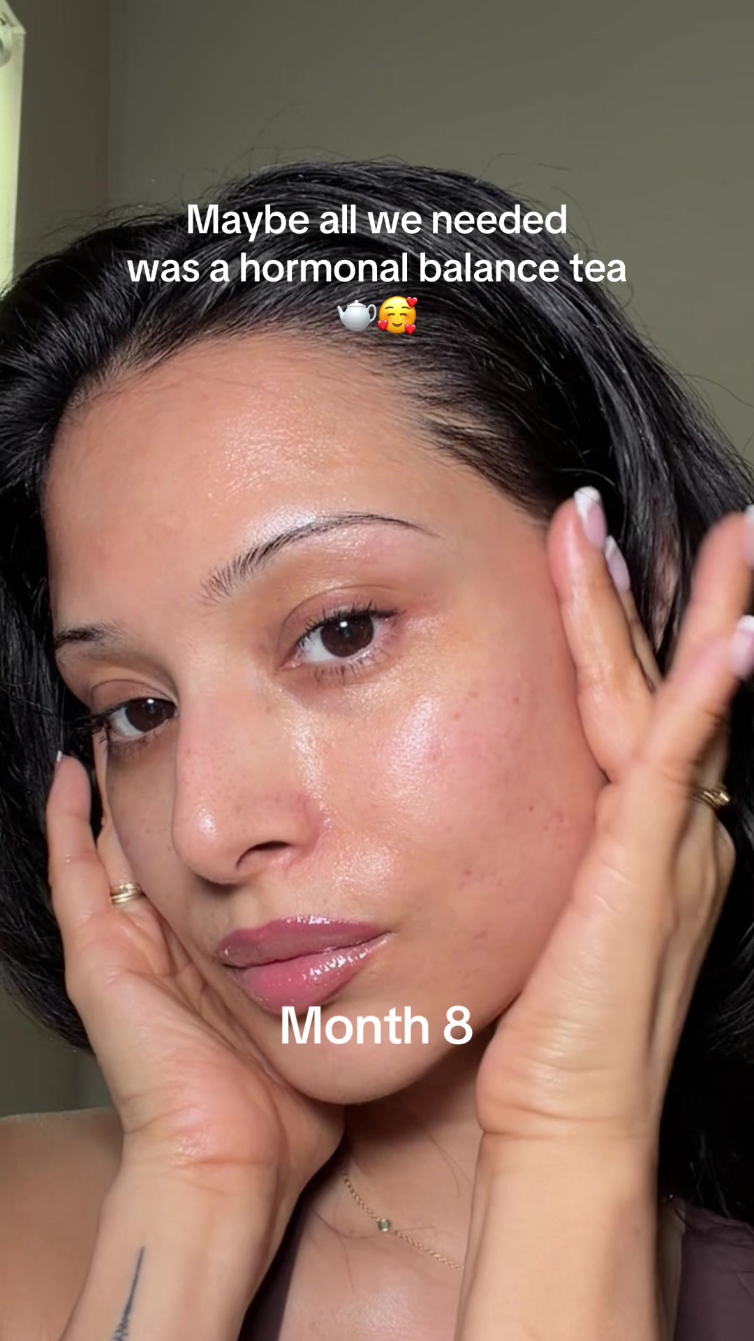 TikTok post by @priscillathachh for Milamend. Caption reads: [...] #hormonalacne #hormonalacnejourney @Milamend.