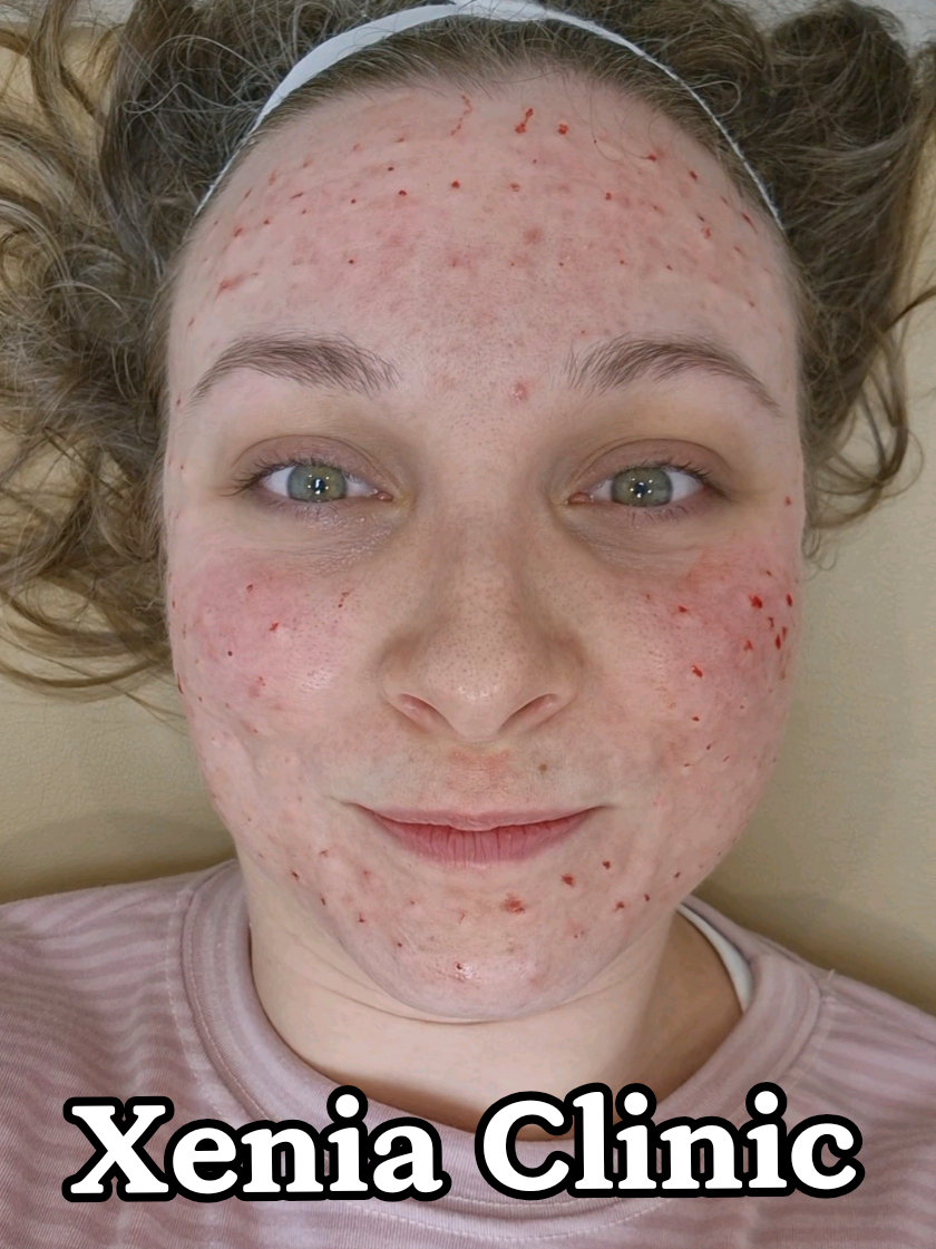 TikTok post by @janedoesasmr for Xenia Clinic. Caption reads: Botox Coréen + Lhala Peel avec @xeniaclinic_eng ....