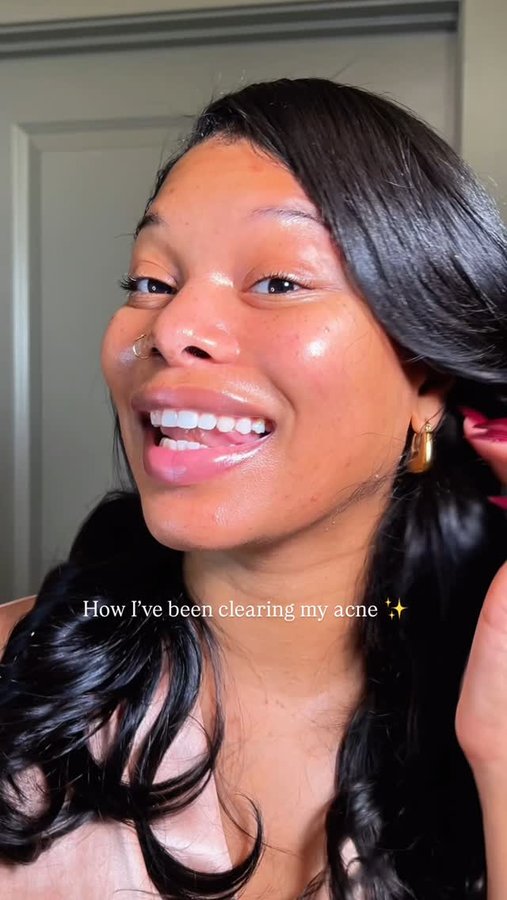 Instagram post by @thee.alexisalize for Bye Bye Blemish. Caption reads: [...] the holidays! This Peel Serum from....